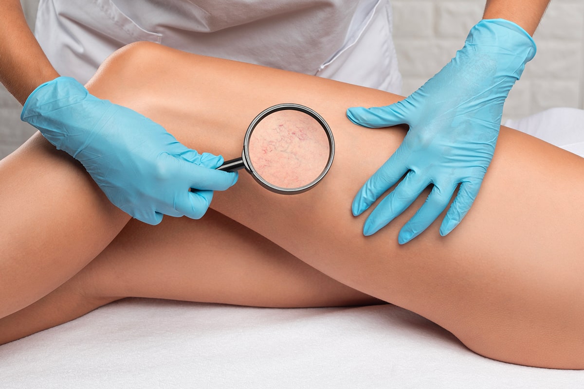 Medico-mostra-la-dilatazione-dei-piccoli-vasi-sanguigni-della-pelle-sulla-gamba